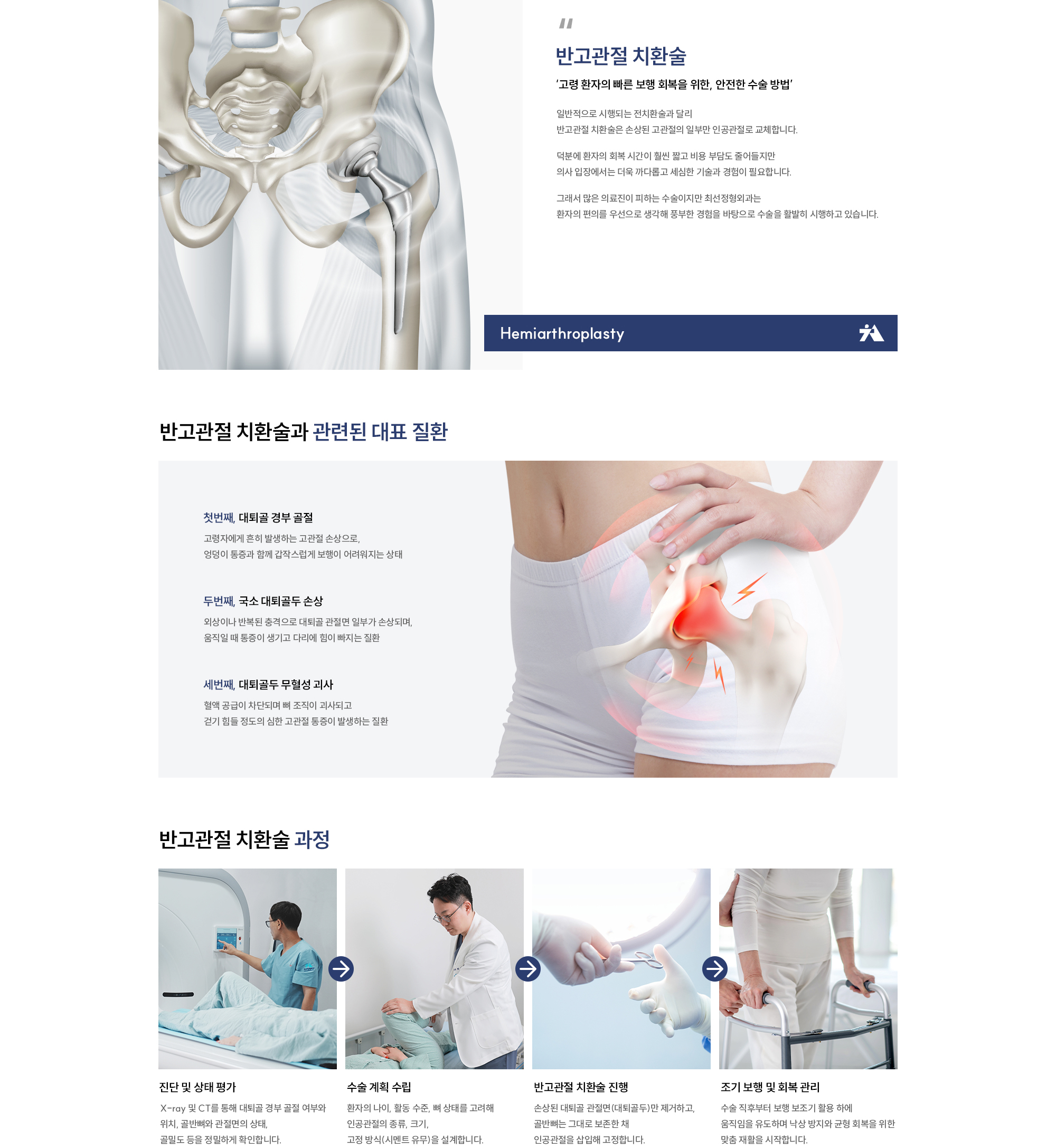 반고관절 치환술